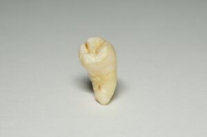 抜歯した親知らず